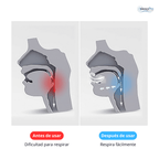 SleepPro – Guarda Bucal Anti-Ronquidos / 3 MSI