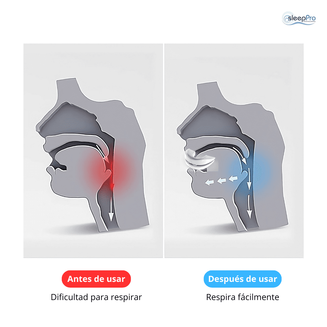 SleepPro – Guarda Bucal Anti-Ronquidos / 3 MSI